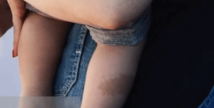 Apollo Bowie-Flynn Rossdale Birth Mark On Right Leg